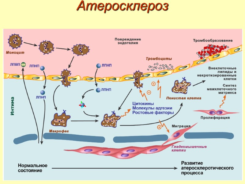 Атеросклероз